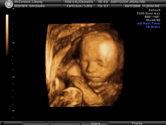 3-D Ultrasound of baby